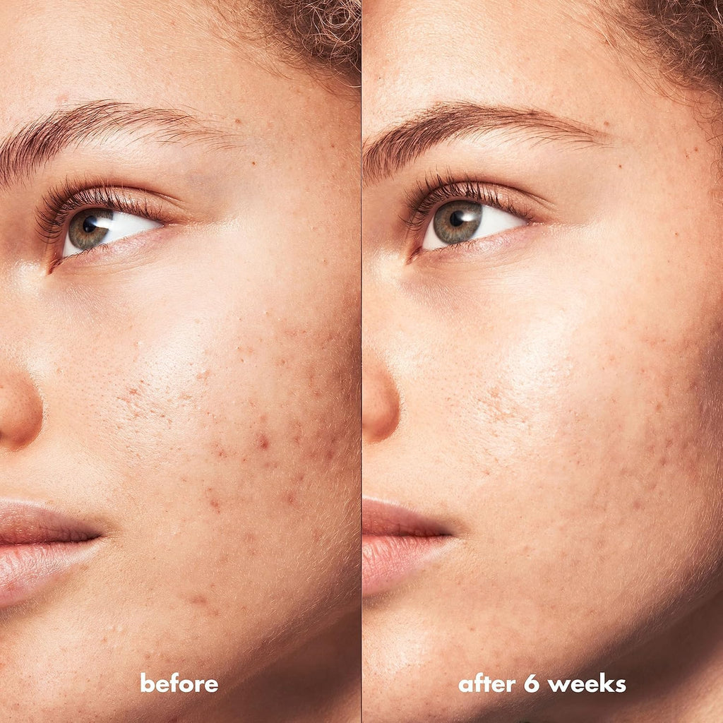 e.l.f. SKIN Blemish Breakthrough Triple-Acid Resurfacing Serum. Hydrating Night Serum For Fighting Blemishes. Helps Improve Skin Tone & Texture