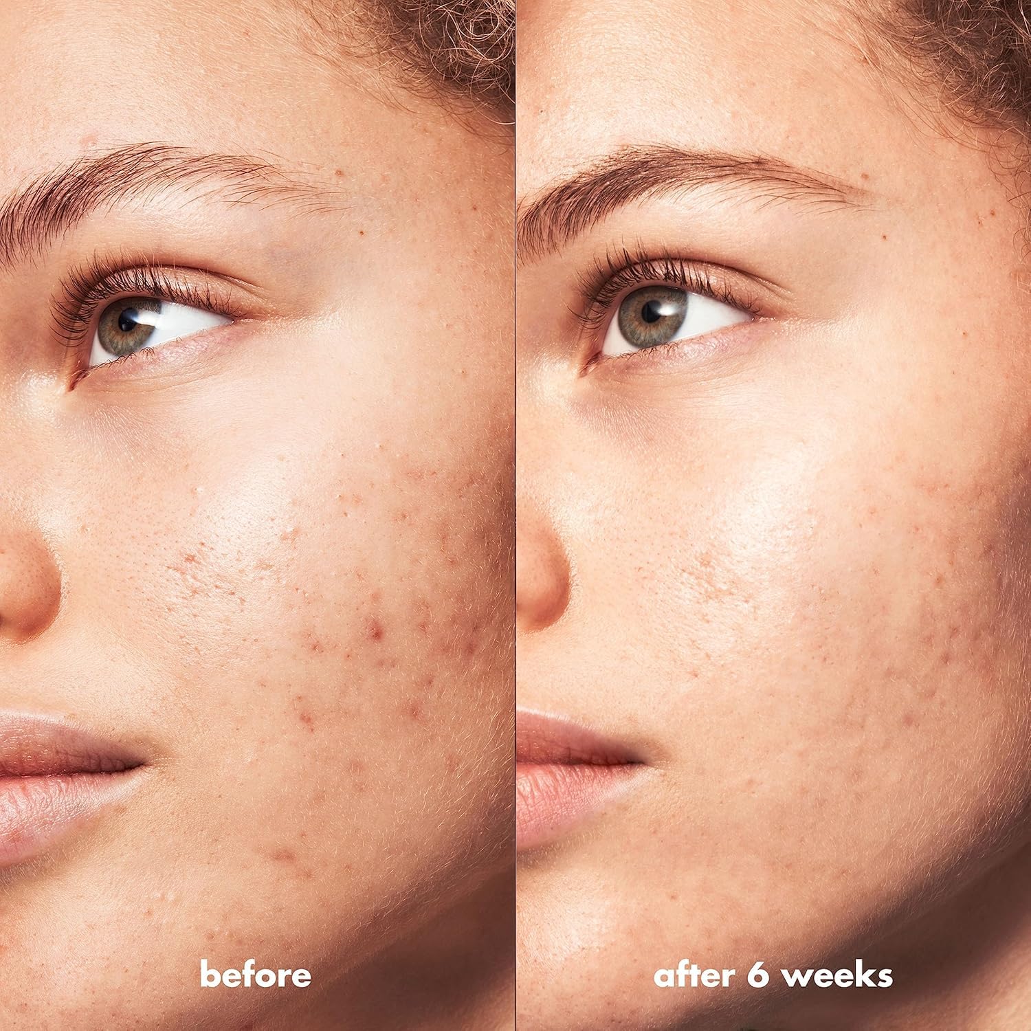 e.l.f. SKIN Blemish Breakthrough Triple-Acid Resurfacing Serum. Hydrating Night Serum For Fighting Blemishes. Helps Improve Skin Tone & Texture