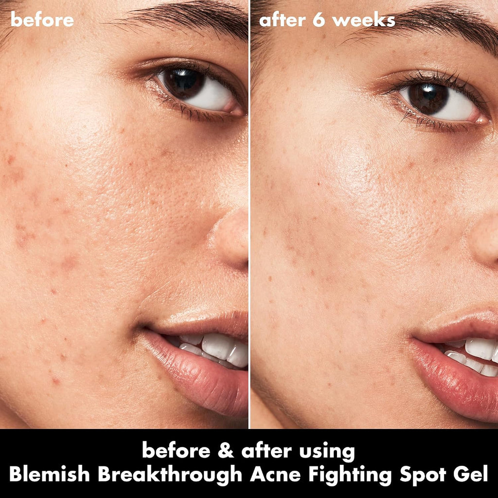 e.l.f. SKIN Blemish Breakthrough Blemish Fighting Spot Gel. Roll-on Blemish Spot Gel For Targeting & Treating Blemishes. Infused With Salicylic Acid