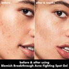 e.l.f. SKIN Blemish Breakthrough Blemish Fighting Spot Gel. Roll-on Blemish Spot Gel For Targeting & Treating Blemishes. Infused With Salicylic Acid