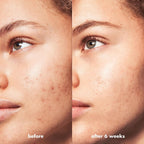e.l.f. SKIN Blemish Breakthrough Clarifying Cleanser. Gel Cleanser For Removing Makeup. Controlling Oil & Clarifying Pores. 1% Salicylic Acid